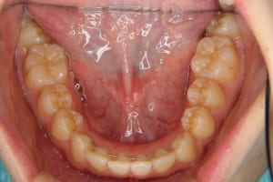 前歯舌側には固定式保定装置セットしています